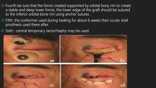  Fourth be sure that the fornix created supported by orbital bony rim to create
a stable and deep lower fornix, the lower edge of the graft should be sutured
to the inferior orbital bone rim using anchor sutures .
 Fifth: the conformer used during healing for about 6 weeks then ocular shell
prosthesis used there after.
 Sixth : central temporary tarsorrhaphy may be used.
 