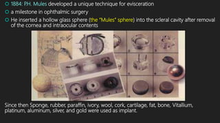  1884: P.H. Mules developed a unique technique for evisceration
 a milestone in ophthalmic surgery
 He inserted a hollow glass sphere (the “Mules” sphere) into the scleral cavity after removal
of the cornea and intraocular contents
Since then Sponge, rubber, paraffin, ivory, wool, cork, cartilage, fat, bone, Vitallium,
platinum, aluminum, silver, and gold were used as implant.
 