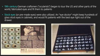 • 19th century:German craftsmen ("ocularists") began to tour the US and other parts of the
world, fabricated eyes and fit them to patients
• Stock eyes (or pre-made eyes) were also utilized. An "eye doctor" might keep hundreds of
glass stock eyes in cabinets, and would fit patients with the best eye right out of the
drawer.
 