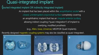 Quasi-integrated implant
(buried integrated implant OR indirectly integrated implant)
An implant that has been placed within the anophthalmic socket with a
closed, uninterrupted conjunctival surface completely covering
an anophthalmic implant that has an irregular anterior surface,
allowing indirect coupling (“quasi-integration”) of implant to
overlying, modified prosthesis
(e.g., Allen, Iowa, Universal, MEDPOR Quad implants).
Recently designed magnetic coupling systems may also be classified as quasi-integrated .
 