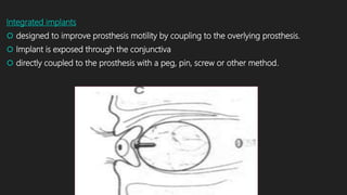 Integrated implants
 designed to improve prosthesis motility by coupling to the overlying prosthesis.
 Implant is exposed through the conjunctiva
 directly coupled to the prosthesis with a peg, pin, screw or other method.
 