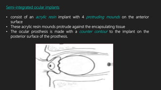 Semi-integrated ocular implants
• consist of an acrylic resin implant with 4 protruding mounds on the anterior
surface
• These acrylic resin mounds protrude against the encapsulating tissue
• The ocular prosthesis is made with a counter contour to the implant on the
posterior surface of the prosthesis.
 