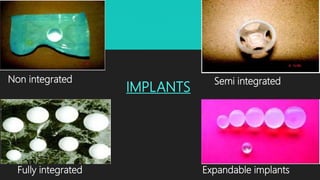 Non integrated Semi integrated
Fully integrated Expandable implants
IMPLANTS
 