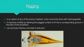 Pegging
 Is an option of any of the porous implants, most commonly done with hydroxyapatite.
 It improves motility by allowing the pegged surface to fit into a corresponding groove in
the back of the prosthesis .
 can promote infection and lead to extrusion
 