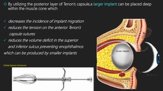  By utilizing the posterior layer of Tenon’s capsule,a larger implant can be placed deep
within the muscle cone which
 decreases the incidence of implant migration
 reduces the tension on the anterior Tenon’s
capsule sutures
 reduces the volume deficit in the superior
and inferior sulcus preventing enophthalmos
which can be produced by smaller implants
Orbital Sphere Introducer
 