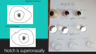 Notch is superonasally
 