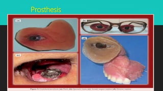 Prosthesis
 