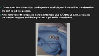  Orientation lines are marked on the patient indelible pencil and will be transferred to
the cast to aid this process.
 After removal of the impression and disinfection, LAB-ANALOGUE CAPS are placed
the transfer magnets and the impression is poured in dental stone.
 