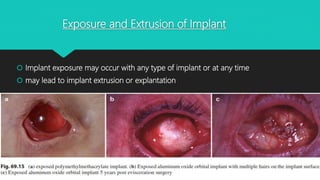 Exposure and Extrusion of Implant
 Implant exposure may occur with any type of implant or at any time
 may lead to implant extrusion or explantation
 