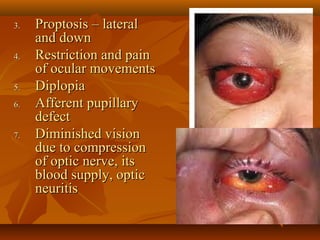 3.. PPrrooppttoossiiss –– llaatteerraall 
aanndd ddoowwnn 
44.. RReessttrriiccttiioonn aanndd ppaaiinn 
ooff ooccuullaarr mmoovveemmeennttss 
55.. DDiippllooppiiaa 
6.. AAffffeerreenntt ppuuppiillllaarryy 
ddeeffeecctt 
7.. DDiimmiinniisshheedd vviissiioonn 
dduuee ttoo ccoommpprreessssiioonn 
ooff ooppttiicc nneerrvvee,, iittss 
bblloooodd ssuuppppllyy,, ooppttiicc 
nneeuurriittiiss 
 