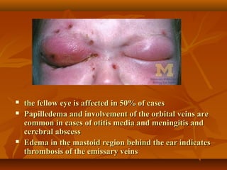  the fellow eye iiss aaffffeecctteedd iinn 5500%% ooff ccaasseess 
 PPaappiilllleeddeemmaa aanndd iinnvvoollvveemmeenntt ooff tthhee oorrbbiittaall vveeiinnss aarree 
ccoommmmoonn iinn ccaasseess ooff oottiittiiss mmeeddiiaa aanndd mmeenniinnggiittiiss aanndd 
cceerreebbrraall aabbsscceessss 
 EEddeemmaa iinn tthhee mmaassttooiidd rreeggiioonn bbeehhiinndd tthhee eeaarr iinnddiiccaatteess 
tthhrroommbboossiiss ooff tthhee eemmiissssaarryy vveeiinnss 
 