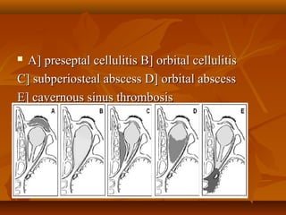  c A] preseptal ceelllluulliittiiss BB]] oorrbbiittaall cceelllluulliittiiss 
CC]] ssuubbppeerriioosstteeaall aabbsscceessss DD]] oorrbbiittaall aabbsscceessss 
EE]] ccaavveerrnnoouuss ssiinnuuss tthhrroommbboossiiss 
 