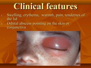 CClliinniiccaall ffeeaattuurreess 
11.. SSwweelllliinngg,, eerryytthheemmaa,, wwaarrmmtthh,, ppaaiinn,, tteennddeerrnneess ooff 
tthhee lliidd 
22.. OOrrbbiittaall aabbsscceessss ppooiinnttiinngg oonn tthhee sskkiinn oorr 
ccoonnjjuunnccttiivvaa 
 