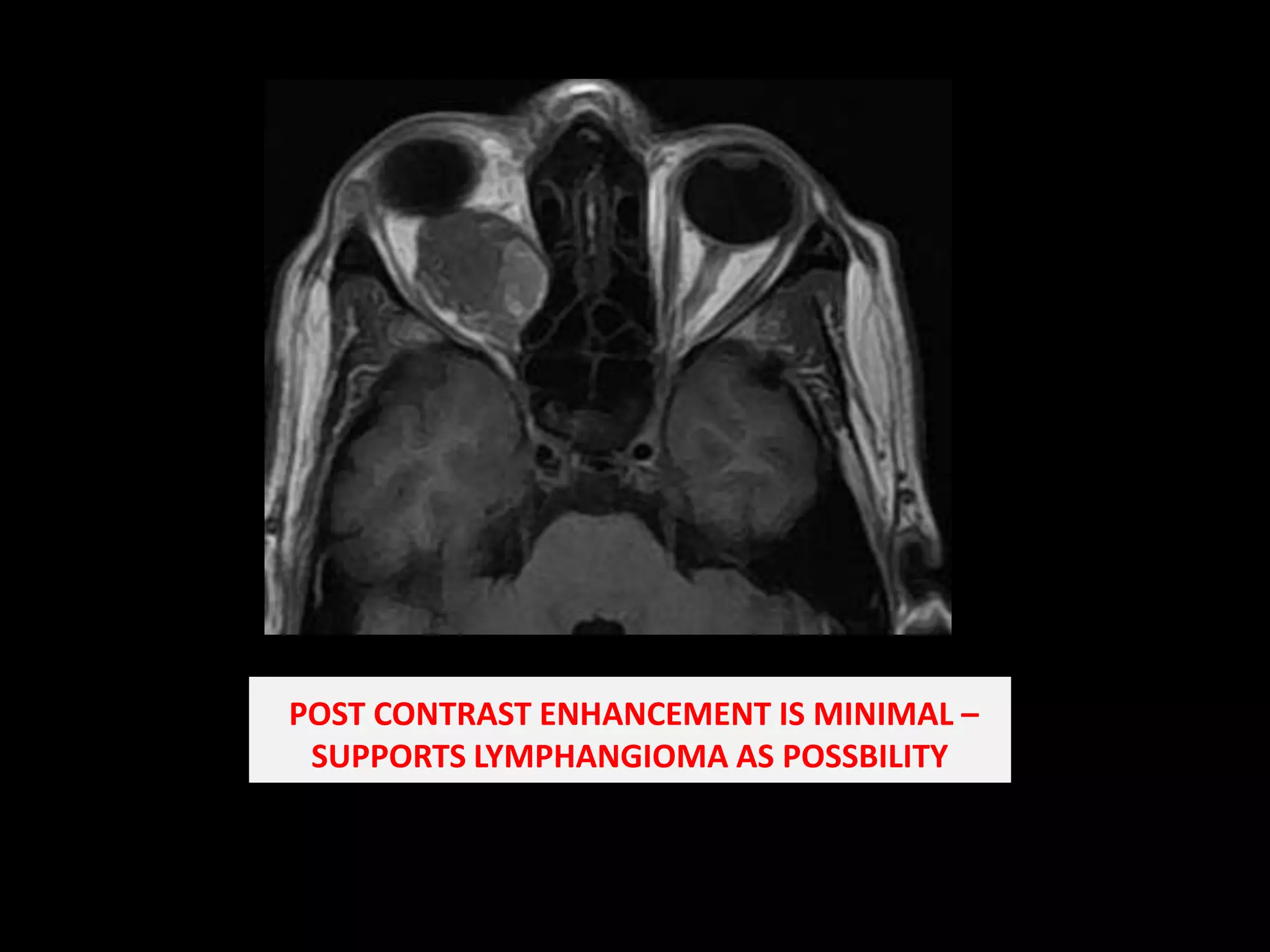 Orbital Lymphangioma in an Adolescent Male: A Case Report and Review of  Literature, image size:2048x1536