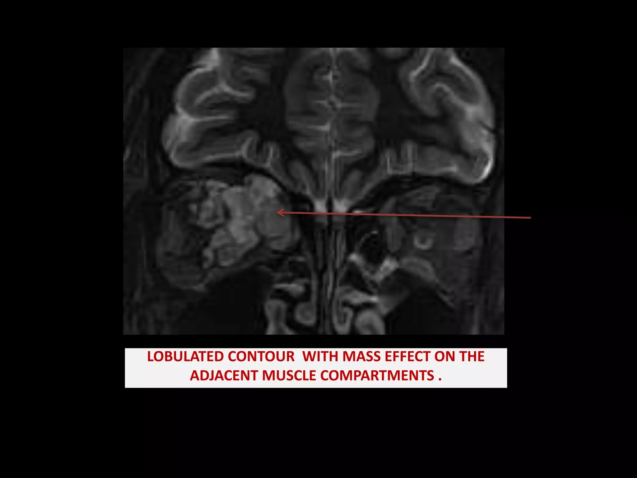 Sclerotherapy for Orbital Lymphangioma – Case Series and Literature Review  | In Vivo, image size:2048x1536