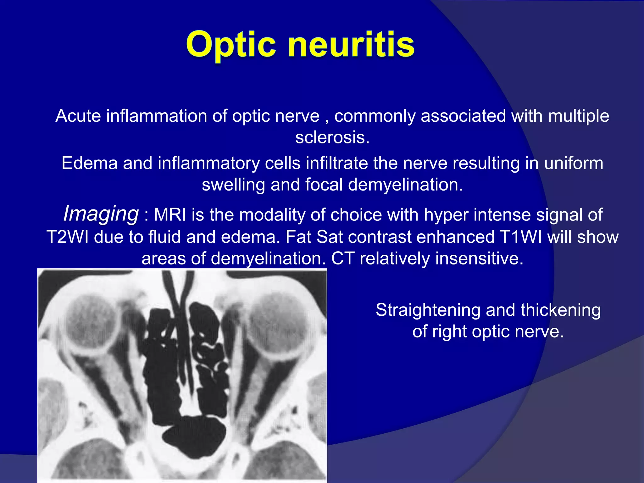 Acute inflammation of optic nerve , commonly associated with multiple
sclerosis.
Edema and inflammatory cells infiltrate the nerve resulting in uniform
swelling and focal demyelination.
Imaging : MRI is the modality of choice with hyper intense signal of
T2WI due to fluid and edema. Fat Sat contrast enhanced T1WI will show
areas of demyelination. CT relatively insensitive.
Straightening and thickening
of right optic nerve.
 