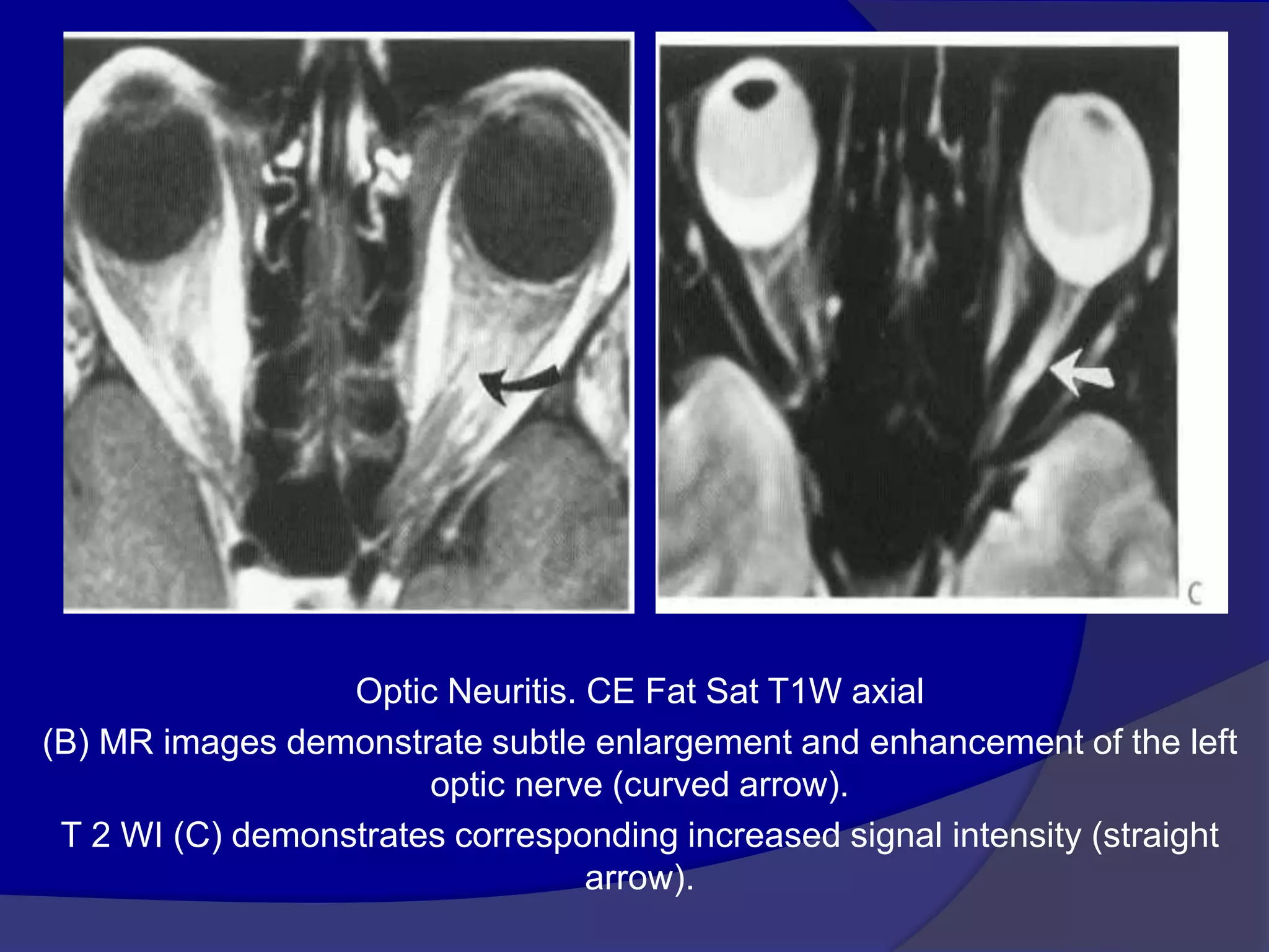 Optic Neuritis. CE Fat Sat T1W axial
(B) MR images demonstrate subtle enlargement and enhancement of the left
optic nerve (curved arrow).
T 2 WI (C) demonstrates corresponding increased signal intensity (straight
arrow).
 
