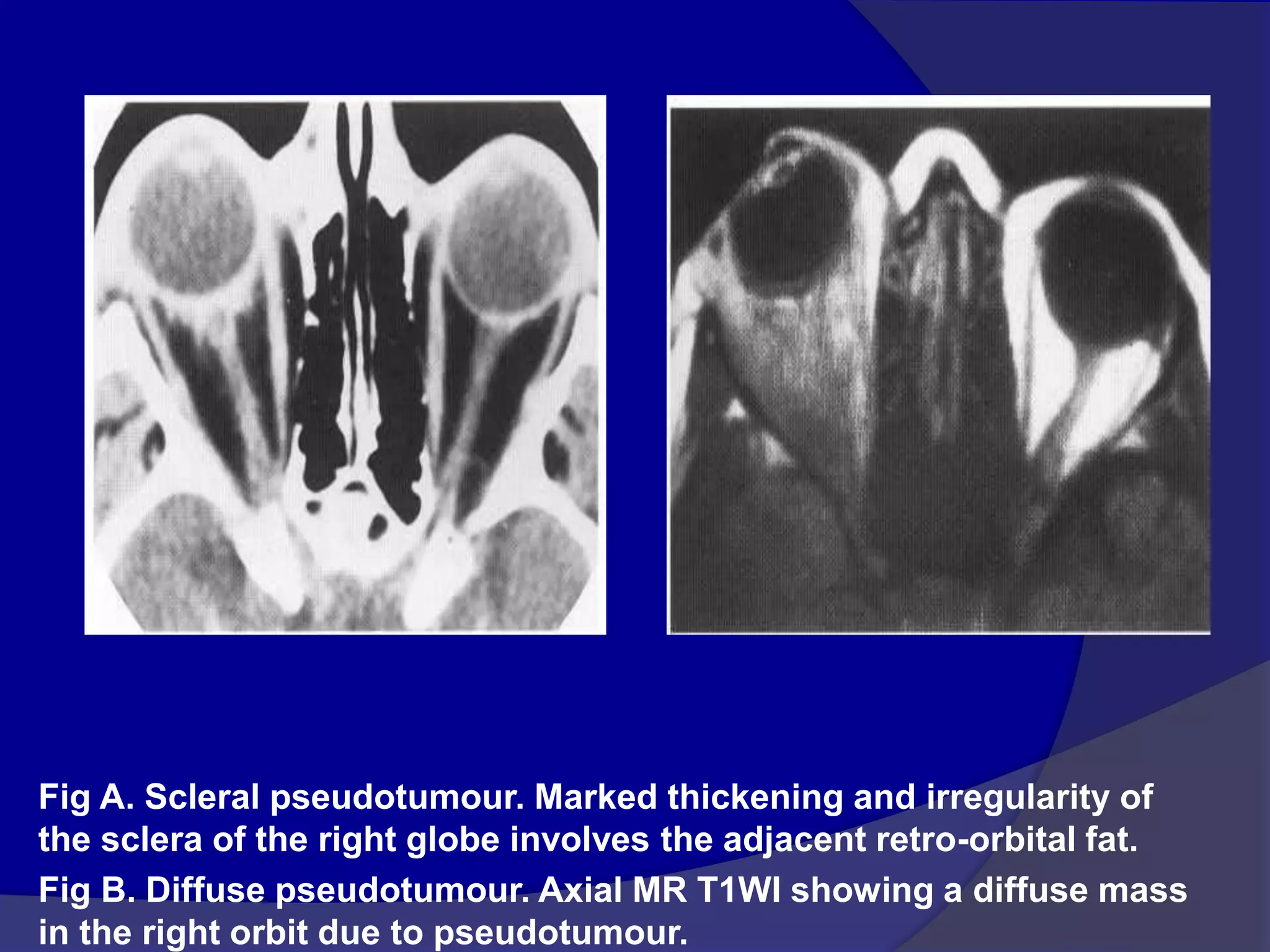 Fig A. Scleral pseudotumour. Marked thickening and irregularity of
the sclera of the right globe involves the adjacent retro-orbital fat.
Fig B. Diffuse pseudotumour. Axial MR T1WI showing a diffuse mass
in the right orbit due to pseudotumour.
 