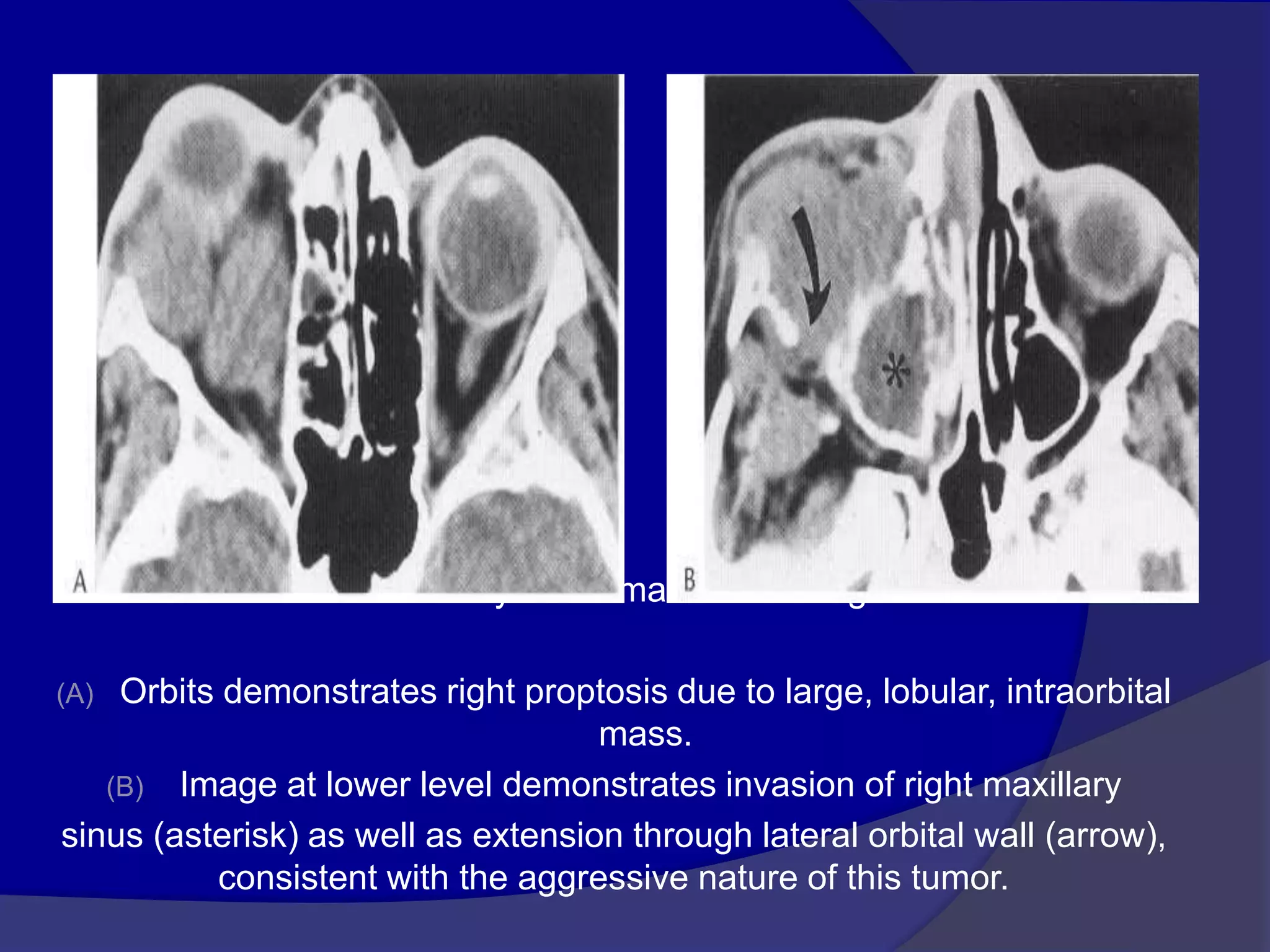 Rhabdomyosarcoma. CECT image
(A) Orbits demonstrates right proptosis due to large, lobular, intraorbital
mass.
(B) Image at lower level demonstrates invasion of right maxillary
sinus (asterisk) as well as extension through lateral orbital wall (arrow),
consistent with the aggressive nature of this tumor.
 