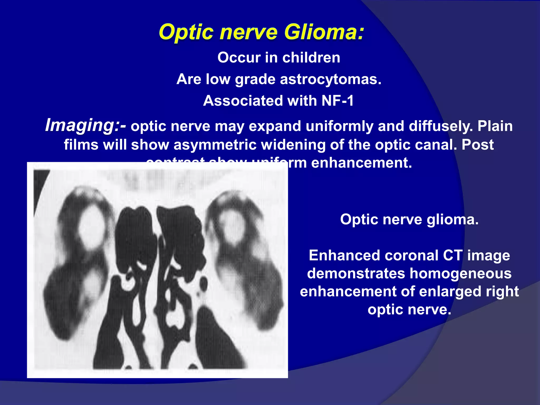 Occur in children
Are low grade astrocytomas.
Associated with NF-1
Imaging:- optic nerve may expand uniformly and diffusely. Plain
films will show asymmetric widening of the optic canal. Post
contrast show uniform enhancement.
Optic nerve glioma.
Enhanced coronal CT image
demonstrates homogeneous
enhancement of enlarged right
optic nerve.
 
