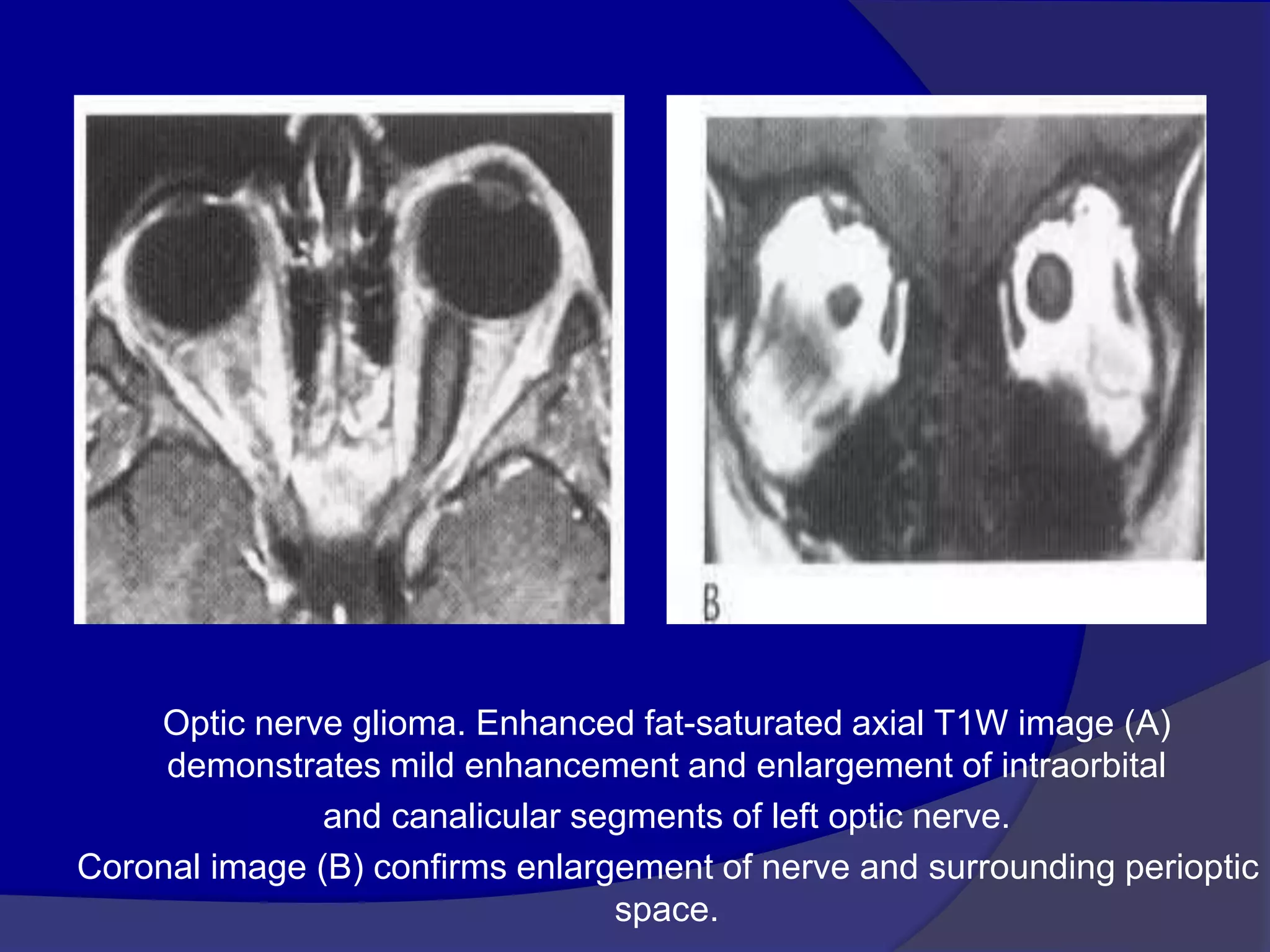 Optic nerve glioma. Enhanced fat-saturated axial T1W image (A)
demonstrates mild enhancement and enlargement of intraorbital
and canalicular segments of left optic nerve.
Coronal image (B) confirms enlargement of nerve and surrounding perioptic
space.
 