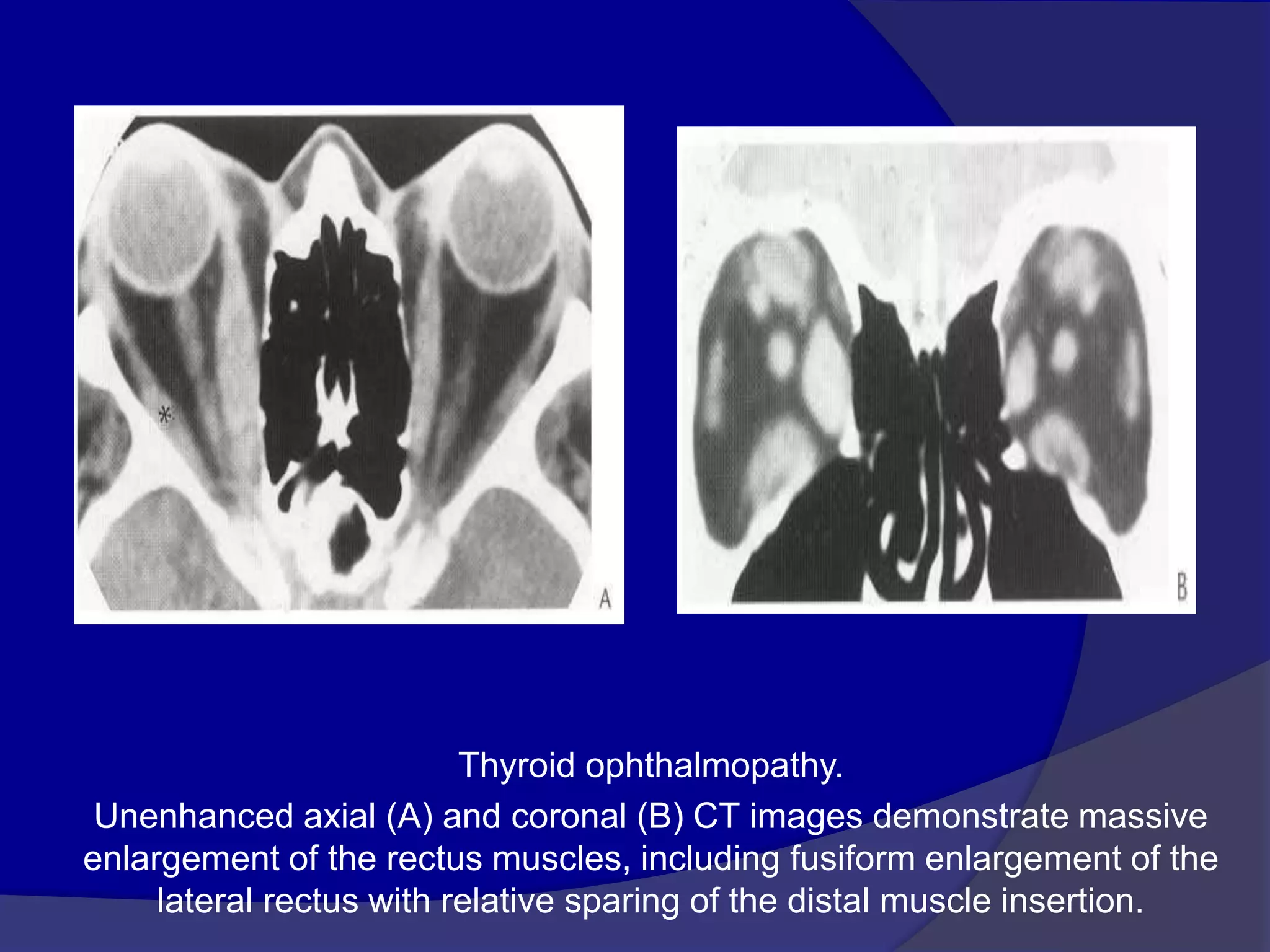 Thyroid ophthalmopathy.
Unenhanced axial (A) and coronal (B) CT images demonstrate massive
enlargement of the rectus muscles, including fusiform enlargement of the
lateral rectus with relative sparing of the distal muscle insertion.
 