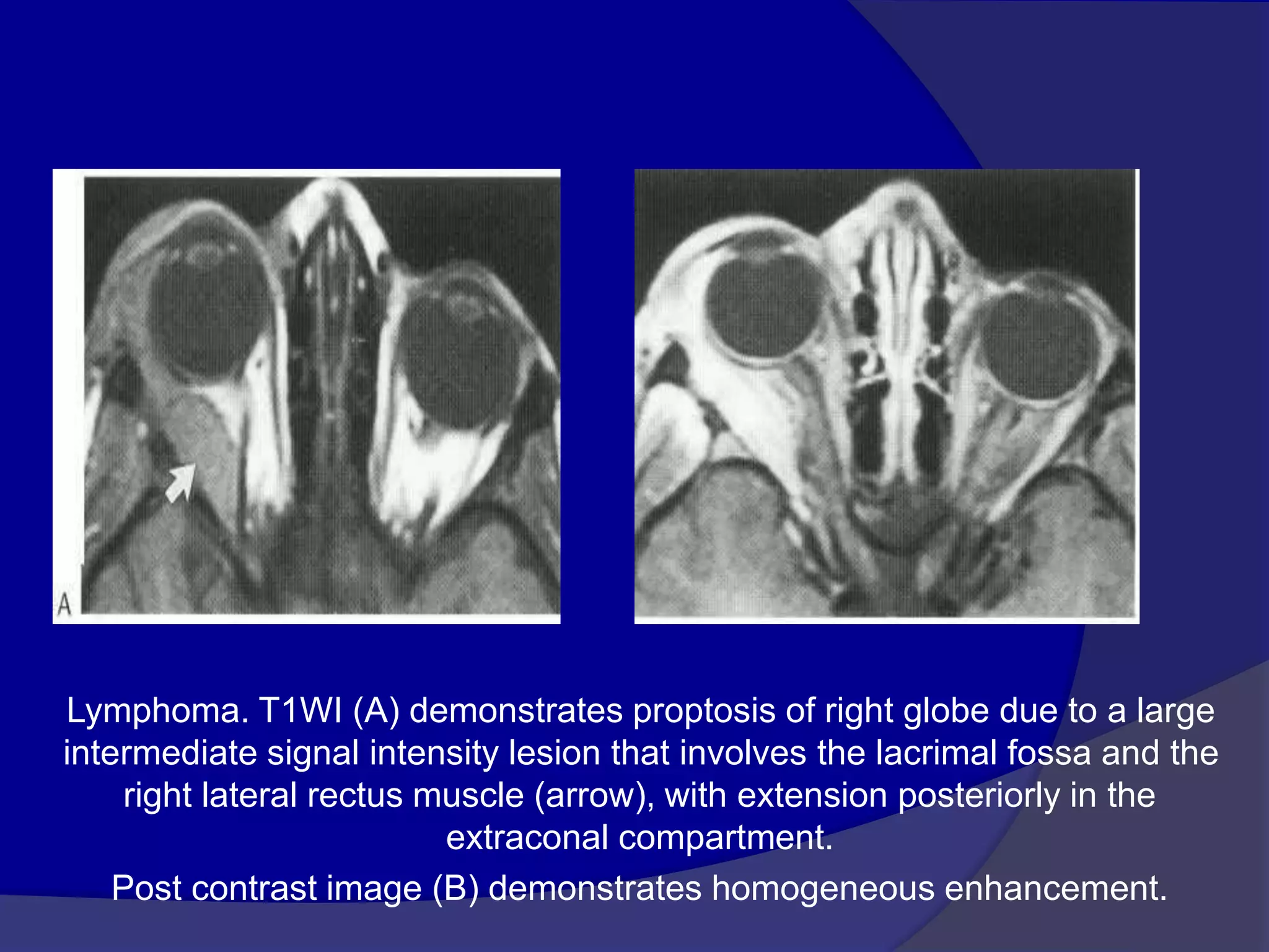 Lymphoma. T1WI (A) demonstrates proptosis of right globe due to a large
intermediate signal intensity lesion that involves the lacrimal fossa and the
right lateral rectus muscle (arrow), with extension posteriorly in the
extraconal compartment.
Post contrast image (B) demonstrates homogeneous enhancement.
 