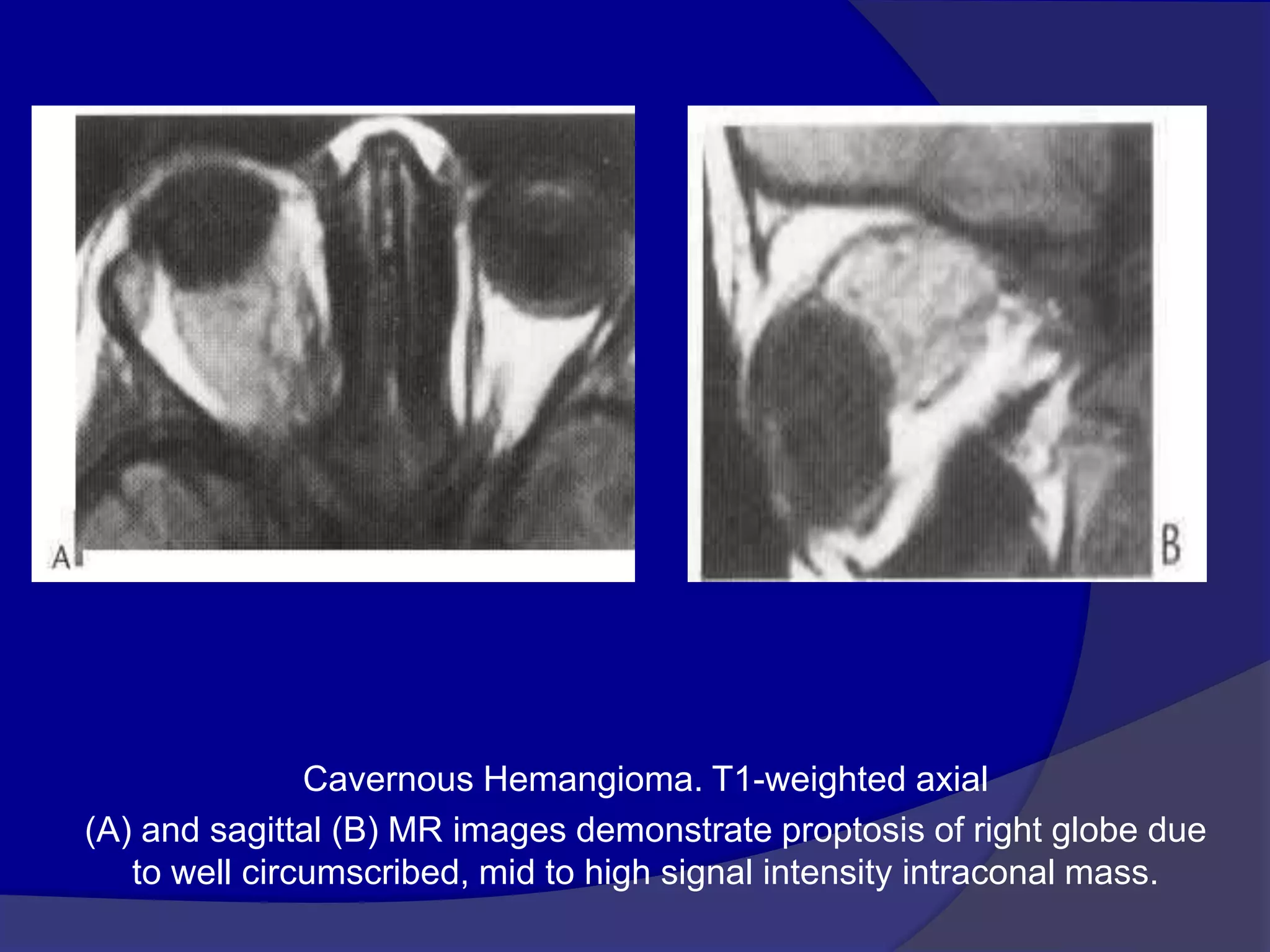Cavernous Hemangioma. T1-weighted axial
(A) and sagittal (B) MR images demonstrate proptosis of right globe due
to well circumscribed, mid to high signal intensity intraconal mass.
 