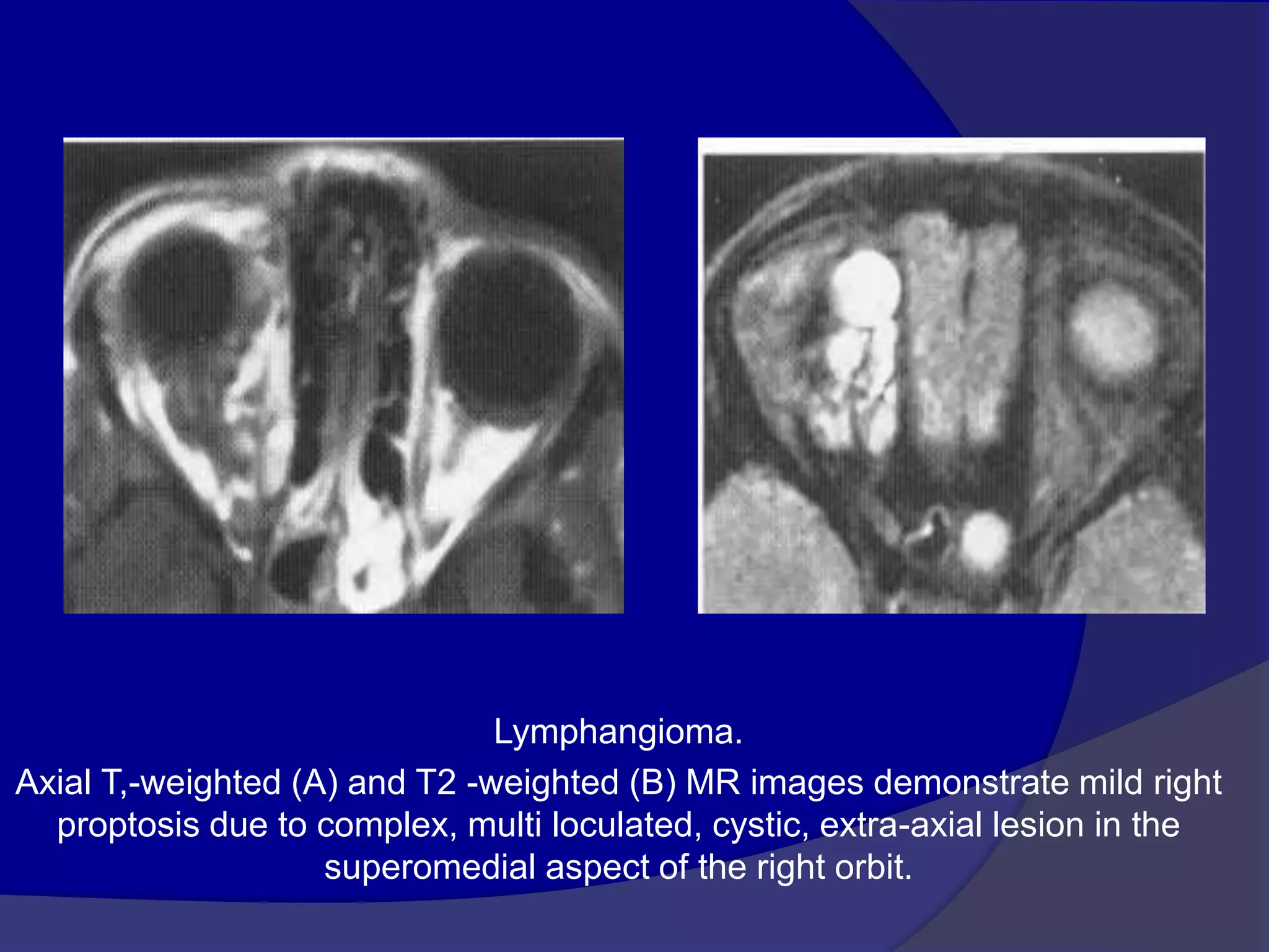 Lymphangioma.
Axial T,-weighted (A) and T2 -weighted (B) MR images demonstrate mild right
proptosis due to complex, multi loculated, cystic, extra-axial lesion in the
superomedial aspect of the right orbit.
 