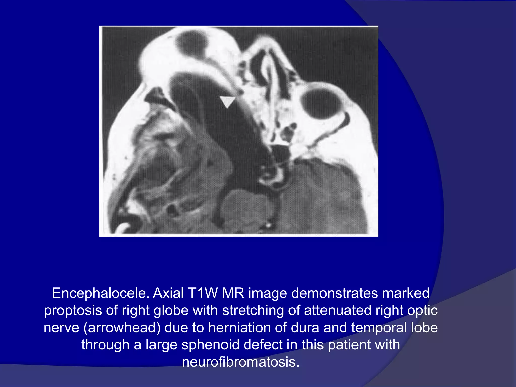Encephalocele. Axial T1W MR image demonstrates marked
proptosis of right globe with stretching of attenuated right optic
nerve (arrowhead) due to herniation of dura and temporal lobe
through a large sphenoid defect in this patient with
neurofibromatosis.
 