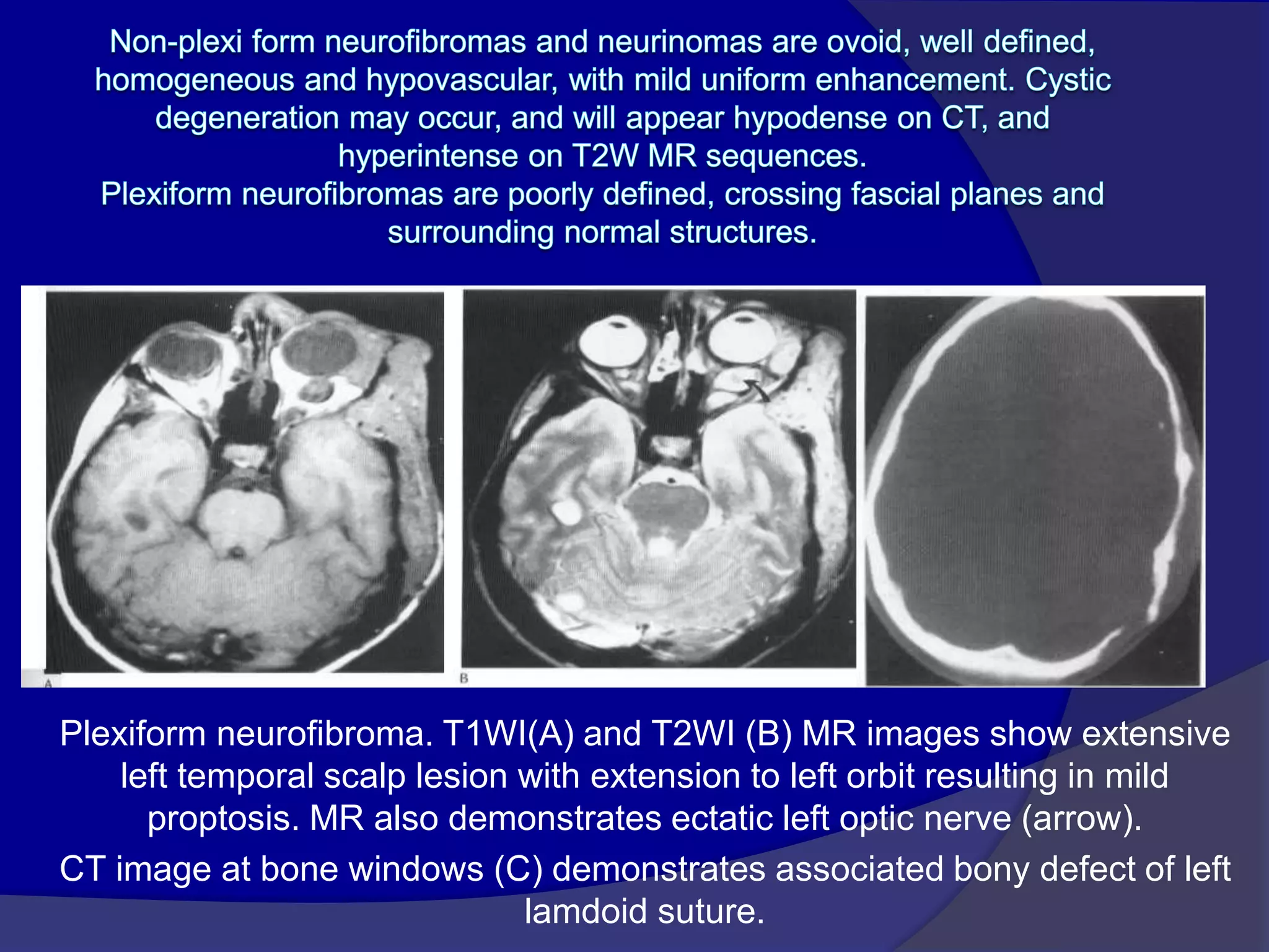 Plexiform neurofibroma. T1WI(A) and T2WI (B) MR images show extensive
left temporal scalp lesion with extension to left orbit resulting in mild
proptosis. MR also demonstrates ectatic left optic nerve (arrow).
CT image at bone windows (C) demonstrates associated bony defect of left
lamdoid suture.
 
