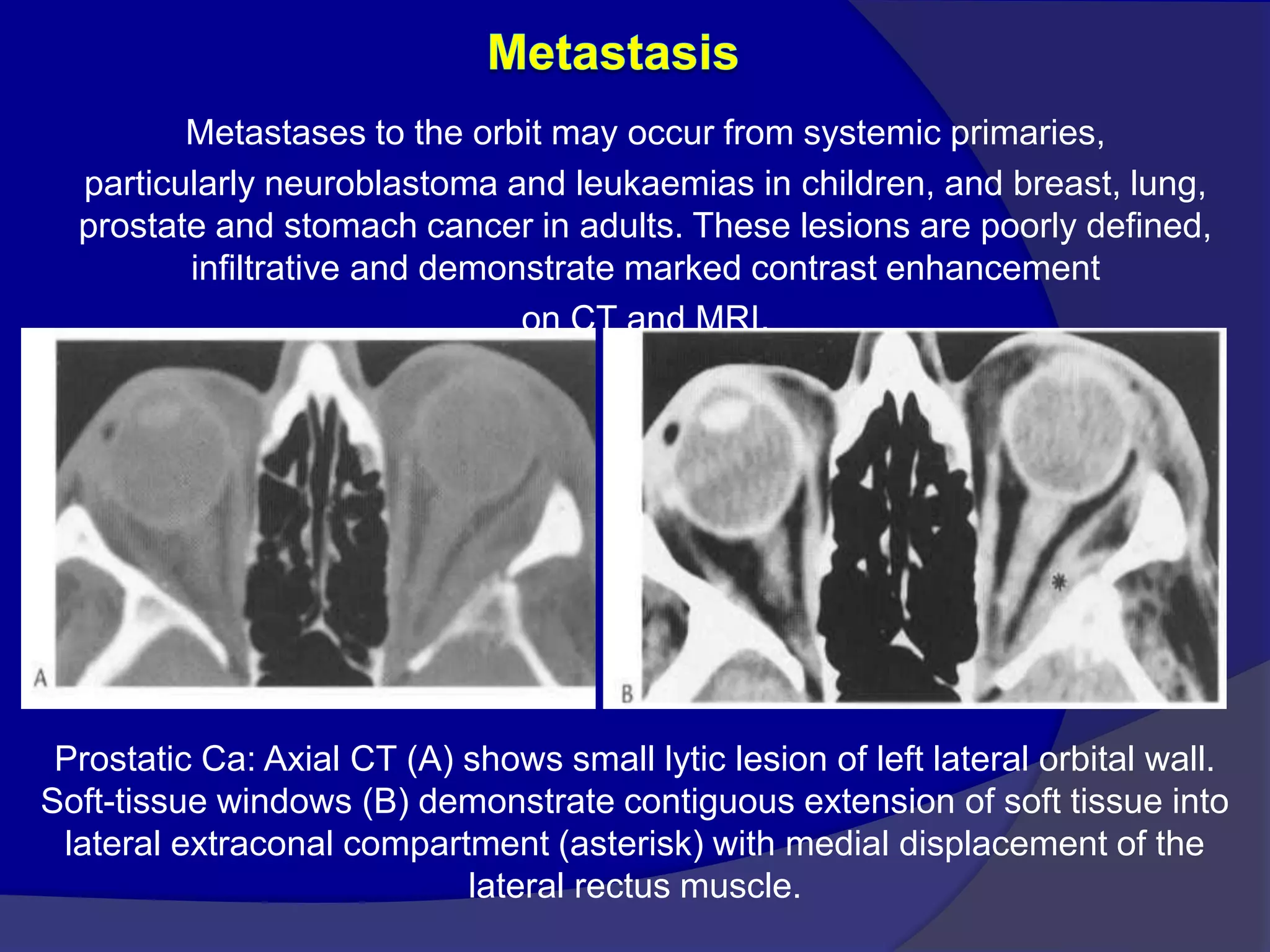 Metastases to the orbit may occur from systemic primaries,
particularly neuroblastoma and leukaemias in children, and breast, lung,
prostate and stomach cancer in adults. These lesions are poorly defined,
infiltrative and demonstrate marked contrast enhancement
on CT and MRI.
Prostatic Ca: Axial CT (A) shows small lytic lesion of left lateral orbital wall.
Soft-tissue windows (B) demonstrate contiguous extension of soft tissue into
lateral extraconal compartment (asterisk) with medial displacement of the
lateral rectus muscle.
 