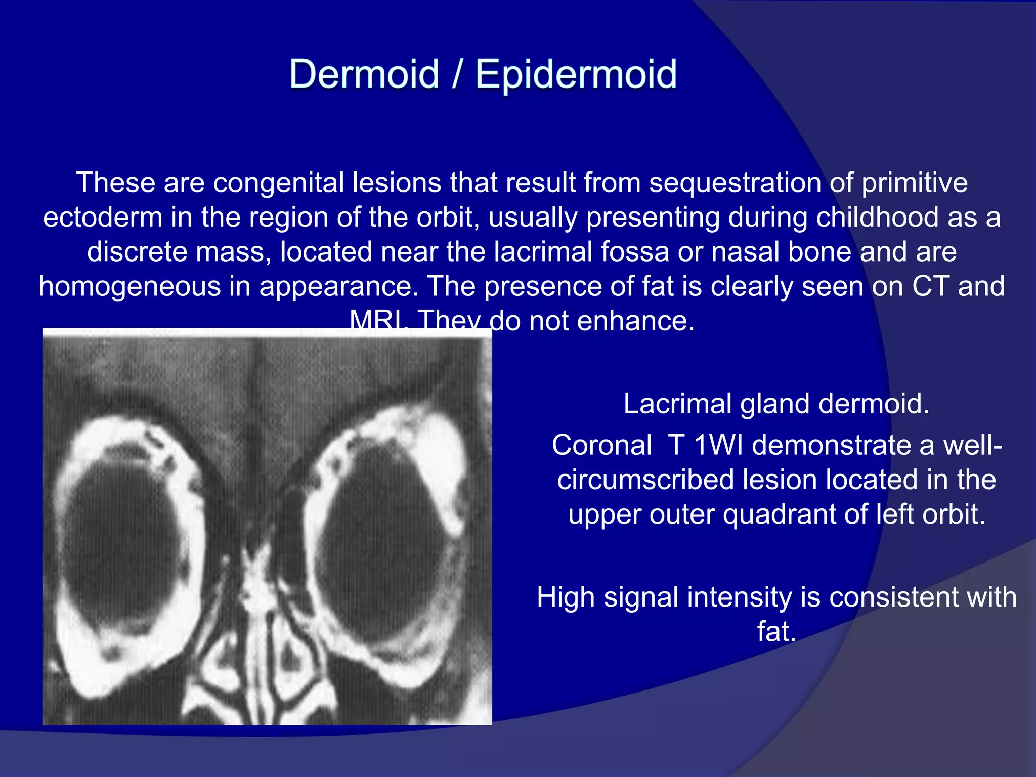 These are congenital lesions that result from sequestration of primitive
ectoderm in the region of the orbit, usually presenting during childhood as a
discrete mass, located near the lacrimal fossa or nasal bone and are
homogeneous in appearance. The presence of fat is clearly seen on CT and
MRI. They do not enhance.
Lacrimal gland dermoid.
Coronal T 1WI demonstrate a well-
circumscribed lesion located in the
upper outer quadrant of left orbit.
High signal intensity is consistent with
fat.
 