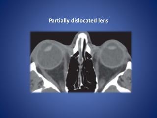 Partially dislocated lens
 