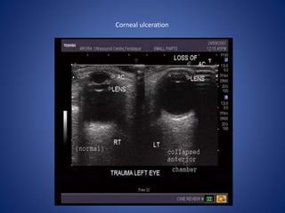 Corneal ulceration
 