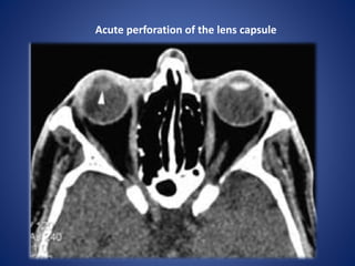 Acute perforation of the lens capsule
 