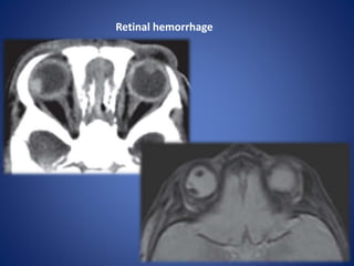 Retinal hemorrhage
 