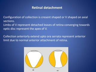 Configuration of collection is cresent shaped or V shaped on axial
sections.
Limbs of V represent detached leaves of retina converging towards
optic disc represent the apex of V.
Collection anteriorly extend upto ora serrata represent anterior
limit due to normal anterior attachment of retina.
Retinal detachment
 