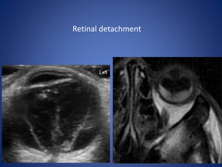 Retinal detachment
 
