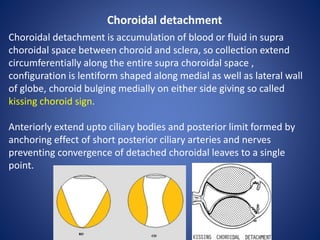 Choroidal detachment
Choroidal detachment is accumulation of blood or fluid in supra
choroidal space between choroid and sclera, so collection extend
circumferentially along the entire supra choroidal space ,
configuration is lentiform shaped along medial as well as lateral wall
of globe, choroid bulging medially on either side giving so called
kissing choroid sign.
Anteriorly extend upto ciliary bodies and posterior limit formed by
anchoring effect of short posterior ciliary arteries and nerves
preventing convergence of detached choroidal leaves to a single
point.
 