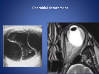 Choroidal detachment
 