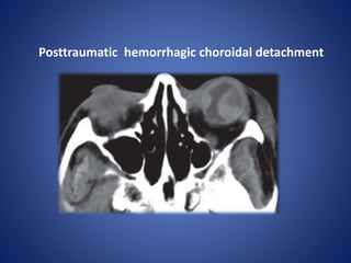Posttraumatic hemorrhagic choroidal detachment
 