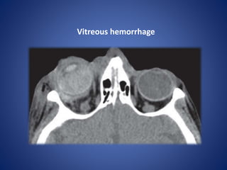 Vitreous hemorrhage
 