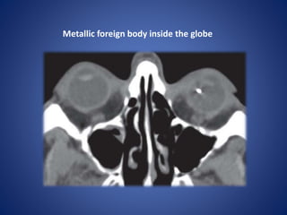 Metallic foreign body inside the globe
 