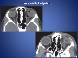 Non-metallic foreign body
 