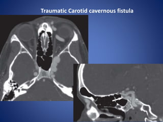 Traumatic Carotid cavernous fistula
 
