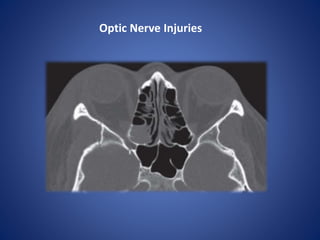 Optic Nerve Injuries
 