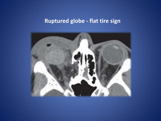 Ruptured globe - flat tire sign
 