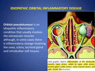 IDIOPATHIC ORBITAL INFLAMMATORY DISEASE
Orbital pseudotumour is an
idiopathic inflammatory
condition that usually involves
the extraocular muscles
although, in some cases there
is inflammatory change involving
the uvea, sclera, lacrimal gland
and retrobulbar soft tissues.
 