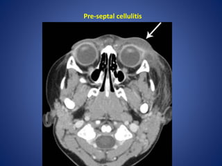 Pre-septal cellulitis
 